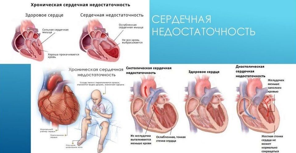 Сердечная недостаточность: симптомы, лечение. ХСН, ОСН. Одышка, отеки